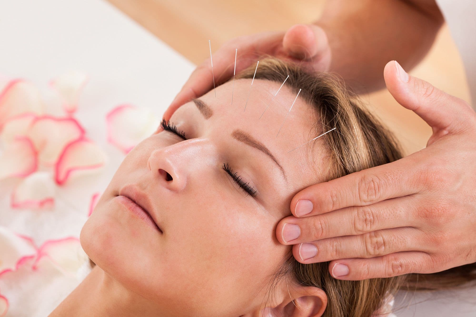 Neck tension headaches relief with acupuncture care