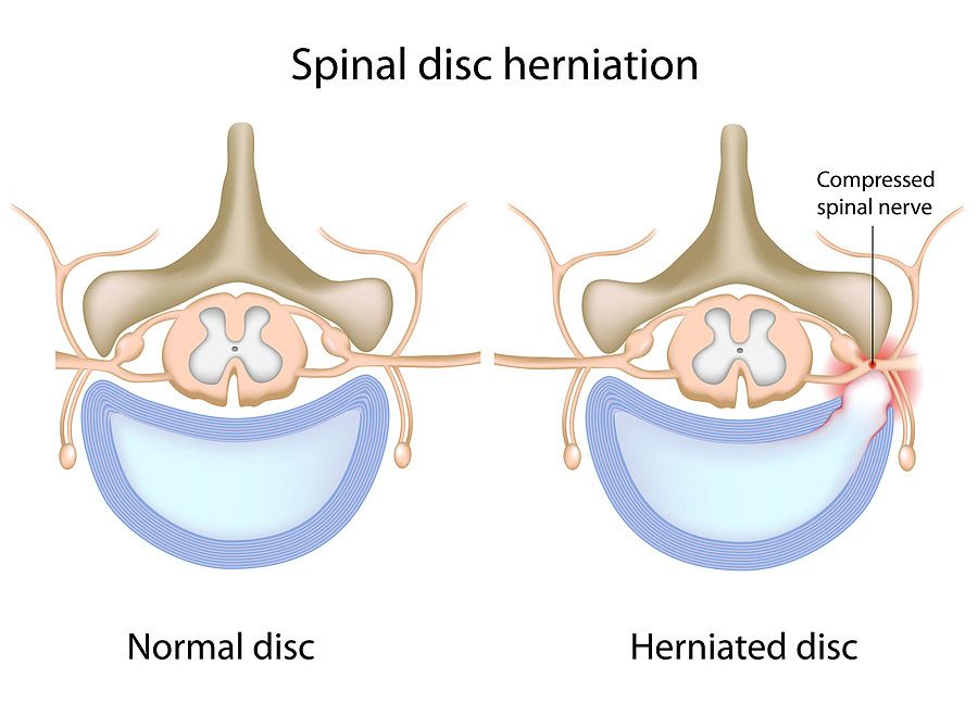 Herniated disc chiropractic treatment at Chiro-Med in Orland Park, IL