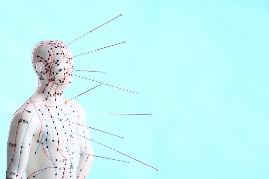 Acupuncture treatment at Chiro-Med in Orland Park, IL